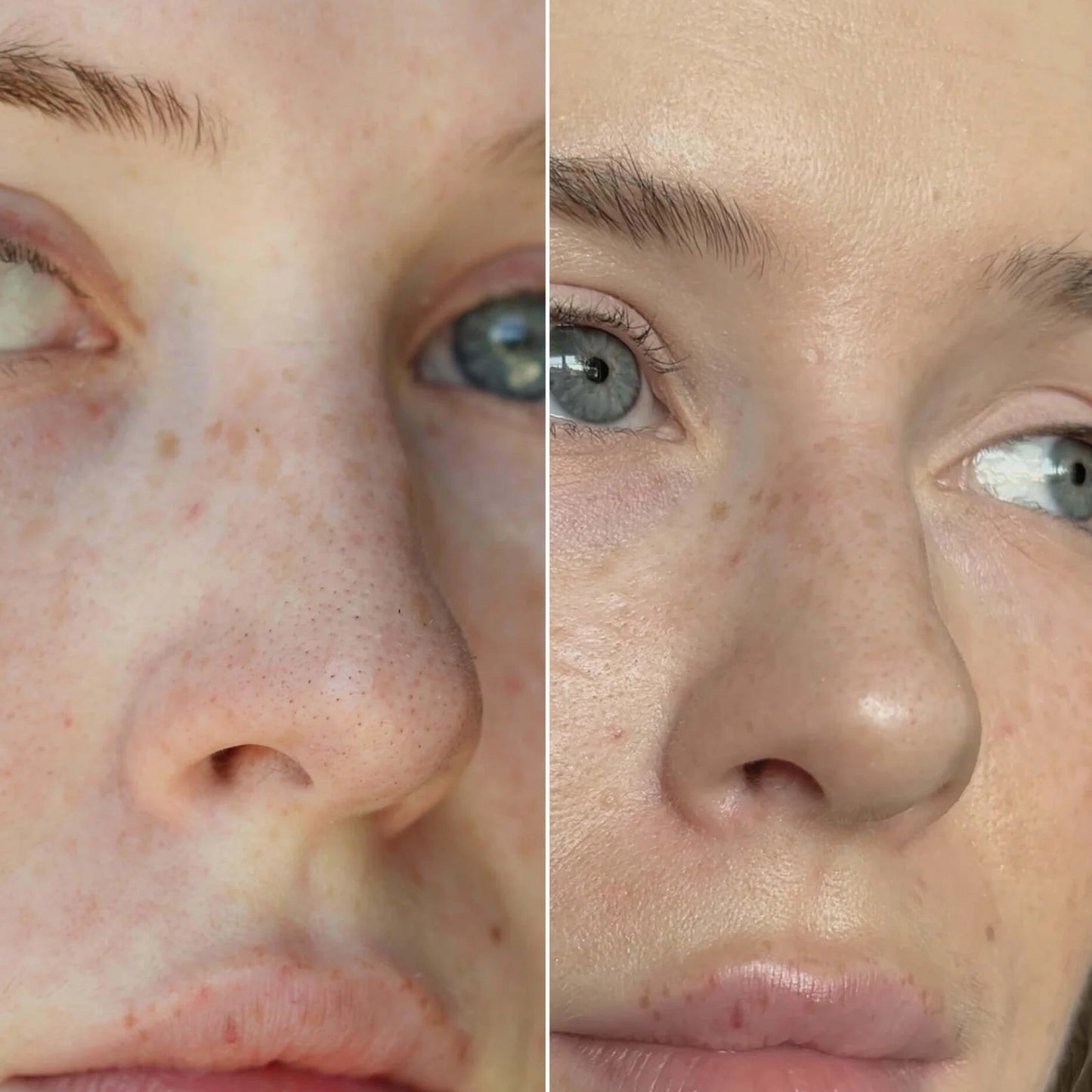 Velea - Хидроколидни лепенки за нос